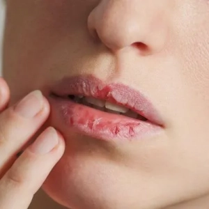 Razpokane ustnice: kaj storiti, kako se boriti proti njim, nasveti kozmetičark in dermatologov