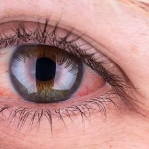 Vzrok za rdeče oči pri odraslih in zdravljenje. Poškodbe in bolezni oči